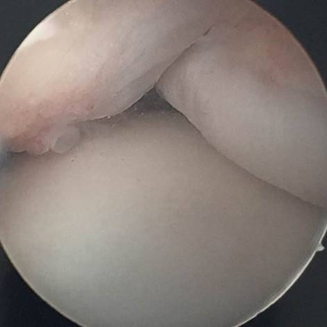 Arthroskopie des oberen Sprunggelenks mit Narbenstrang