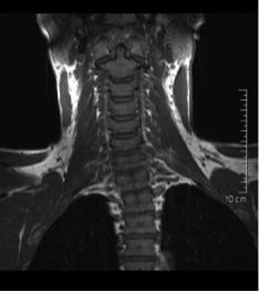 MRT ISG (Iliosakralgelenk) - Aufnahme