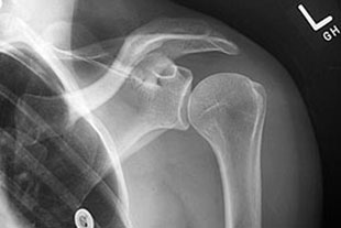 Röntgenbild des Schultergelenks